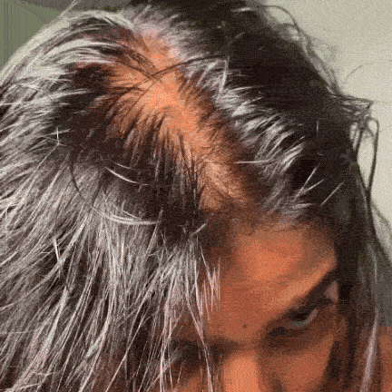 Hair Fall Is More Common